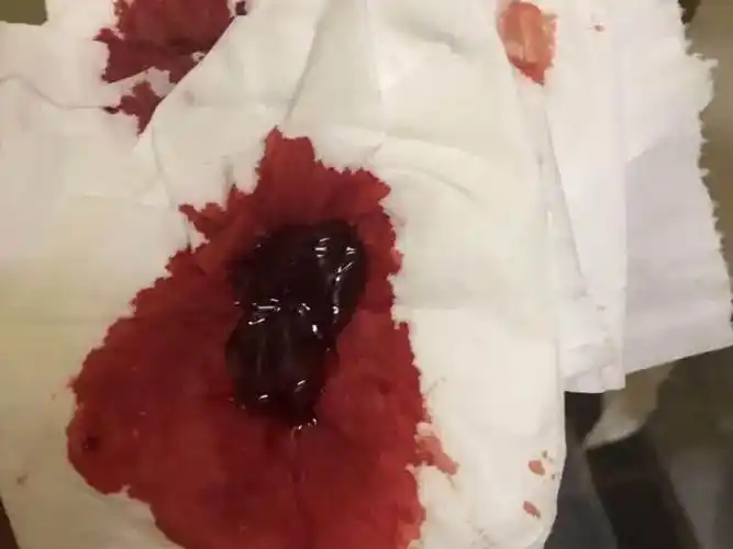 而孕囊是有厚壁的囊性结构,血块从肉眼可以看出颜色呈现暗红色的块状