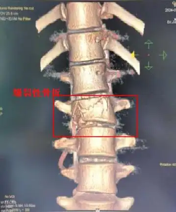 贪玩一"跳",20岁男子腰椎骨折险瘫痪
