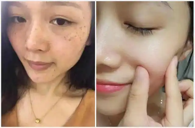 激光祛斑术前术后效果对比图